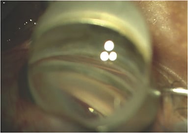 Figure 1. Kahook dual blade (KDB; New World Medical) approaching the angle. Photo courtesy of Dr. Chang