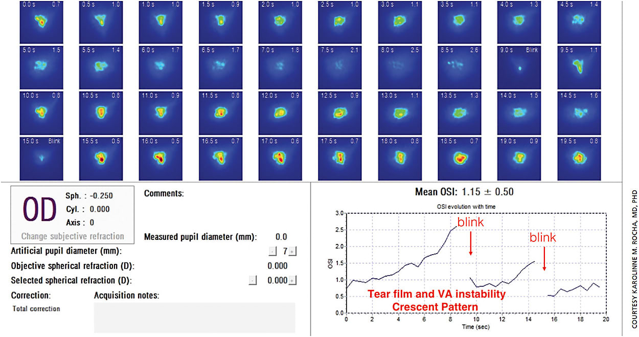 Figure 3. Tear film instability in this unhappy multifocal IOL patient is shown in the dynamic measurement of a point-spread function spanning a 20-second interval.