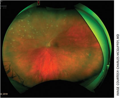 Figure 2. Multifocal, hypopigmented lesions of the left eye.