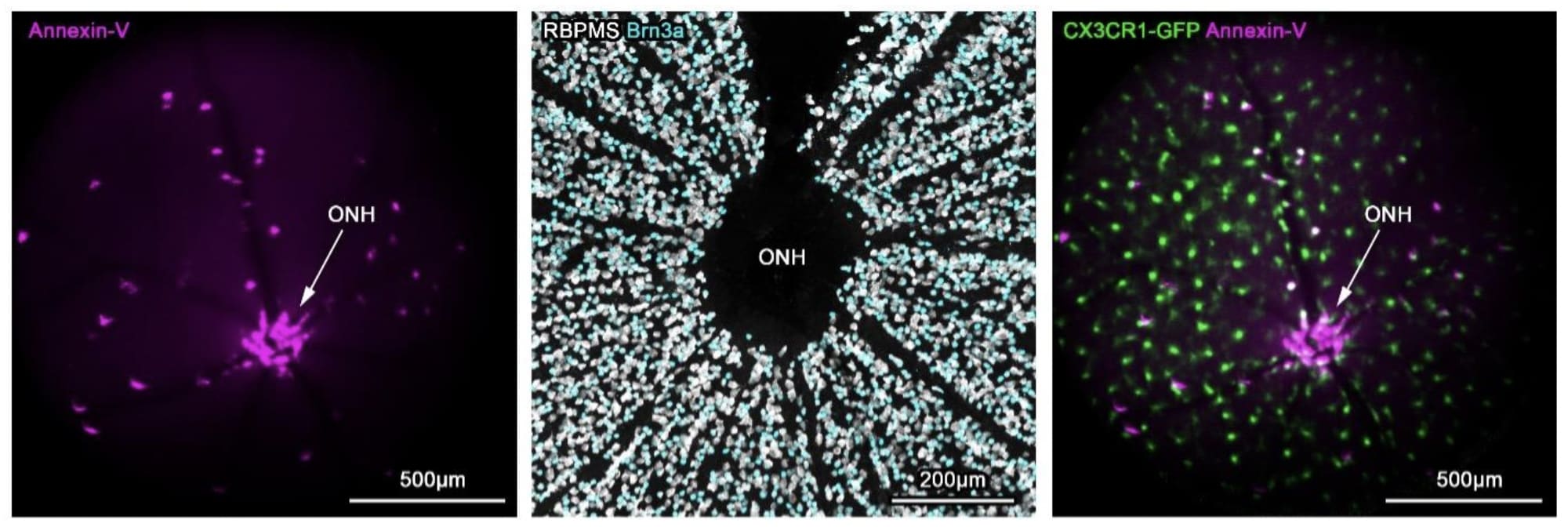 Spectral-domain optical coherence tomography (SD-OCT) shows annexin-V labeling of apoptosis at the optic nerve head (OHN) in a control retina (left). Immunostaining of retinal ganglion cells shown surrounding the OHN (middle). On SD-OCT microglial cells are labeled green, and subset are also labeled with annexin-V. Image courtesy: NEI