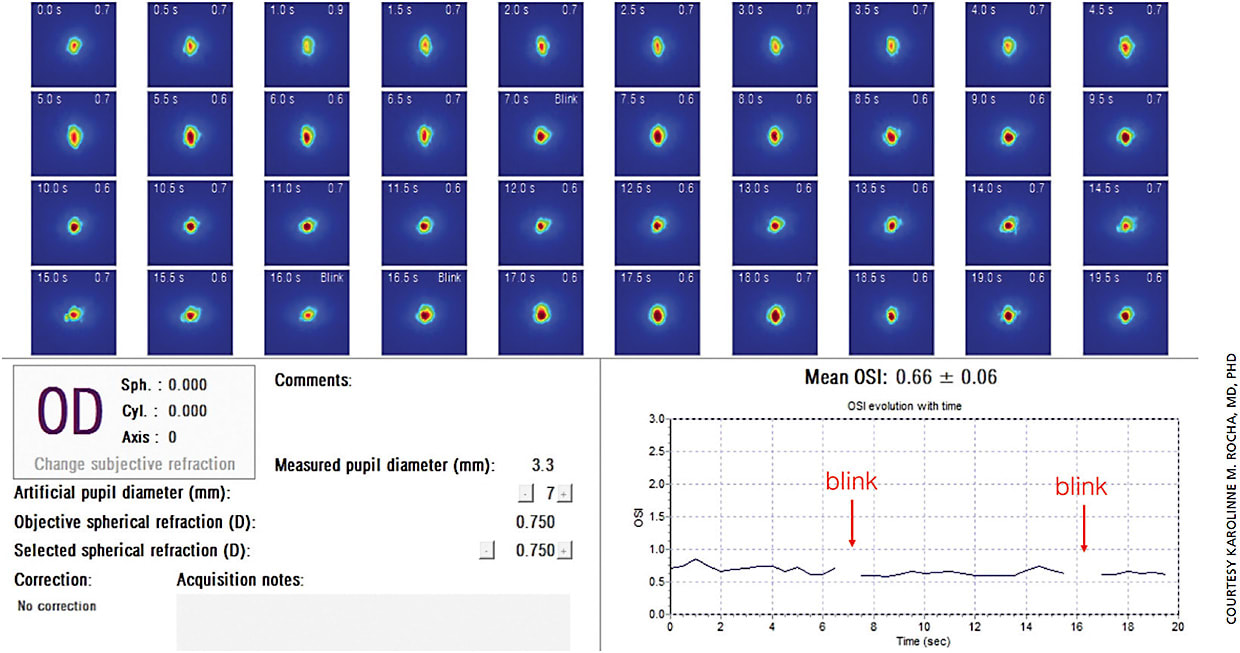 Figure 2. Post-LASIK patient is a 35-year-old female. Shown is the dynamic measurement of the point-spread function that spans a 20-second interval.