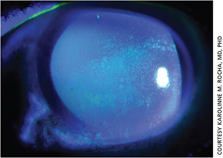 Figure 1. Slit lamp photo of diffuse punctate fluorescein stain consistent with severe keratoconjunctivitis sicca.