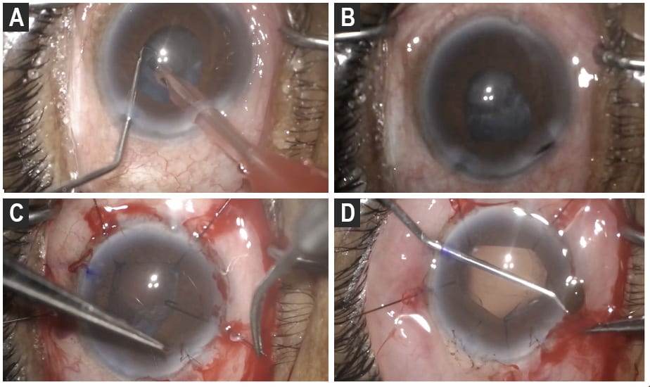 Figure 1: Loss of pupillary dilation occurring as phacoemulsification is started (A). Iris prolapse through the main incision prior to insertion of iris hooks (B). Orientation of iris hook as well as sutured main incision located on inferior temporal aspect of eye (C). Iris prolapse following the removal of the iris hook for insertion of IOL (D).