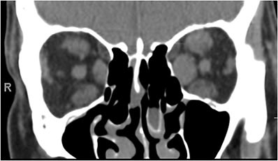 Figure 3B. Coronal view CT image demonstrating bilateral enlargement of the inferior, medial and superior rectus muscles in the orbits. The optic nerve is seen centrally. Image courtesy Shakthi Kanagalingam, MD.