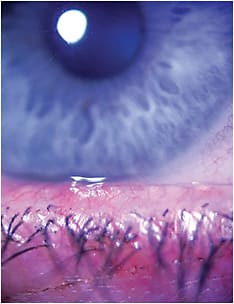 MGD in an eye makeup wearer.
Image courtesy of Dr. Selena McGee