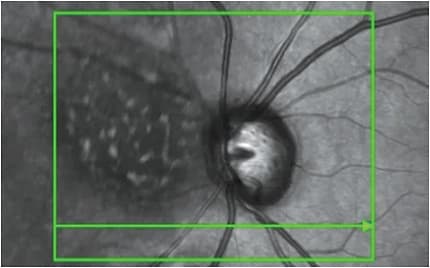 Note the lipofuscin in this patient who has a choroidal mass.