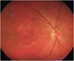 IMAGE: Note the drusen around the macula in dry AMD.