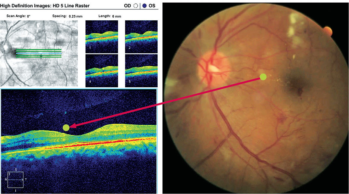 Figure 1. Left eye of a 55-year-old patient who has diabetes, diagnosed over 10 years ago. Note the characteristic diabetic fundus changes and how the OCT (left panel) exquisitely shows the exudates perilously close to the center of the macula. All images provided by Leo Semes, O.D., F.A.A.O.