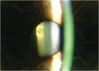 Picture 1: A small, off-center posterior sub-capsular cataract will cause a loss of visual sharpness and a decrease in night driving. Image courtesy of Dr. Jason Miller