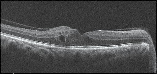 Note this patient’s DME, as seen on OCT.
Courtesy of Sherrol A. Reynolds, O.D., F.A.A.O.