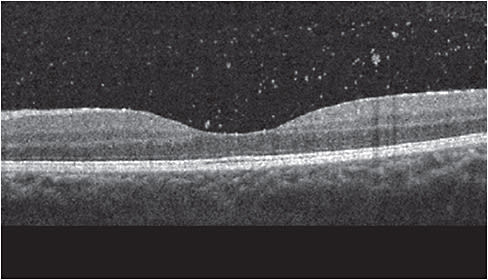 SD-OCT imaging shows active vitritis in a patient with posterior uveitis.
Image courtesy of Dr. Sherrol A. Reynolds
