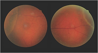 Does the patient have acquired retinoschisis or retinal detachment?
Image courtesy of Dr. Reynolds