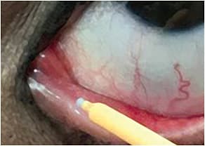 Punctal occlusion after controlling inflammation
Image courtesy of Dr. Johnston