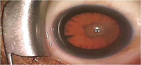 O.D.s should diagnose and manage DED prior to cataract surgery (above).
Image courtesy of Johnny Gayton, M.D.