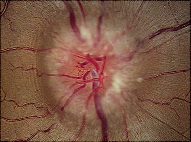 Lymphoma patient with an optic nerve infiltration.
Image courtesy of Dr. Aaron Gold