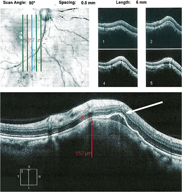 Figure 6. Thickness measurement (552 μm) and RPE detachment (arrow) on cross-sectional high-resolution scan through a low-risk choroidal nevus.
