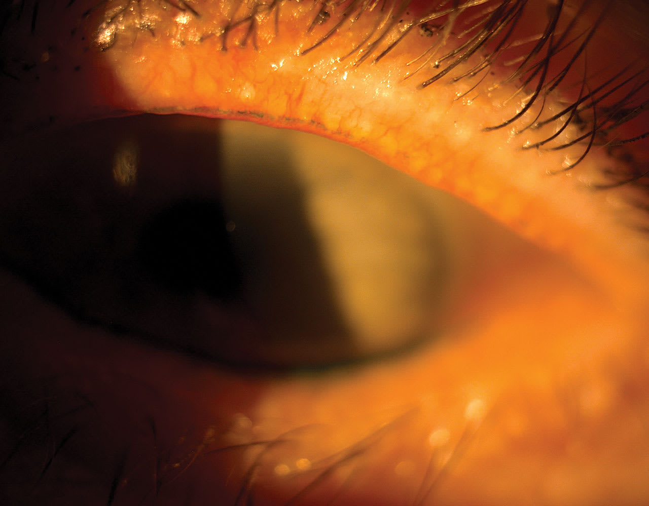 Conjunctival hyperemia, shown here, falls under category 3 of the TFOS DEWS III report, ocular surface abnormalities. (Photo courtesy: Lisa Hornick, OD, MBA, FAAO)