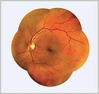 IMAGE: 90° mosaic imaging of the retina.