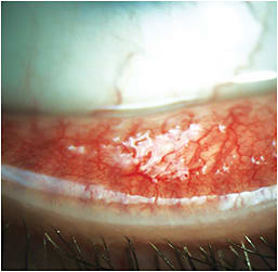 Papillae in allergic conjunctivitis.
