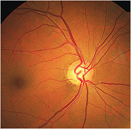 Note the inferior temporal retinal nerve fiber layer wedge defect OD.
Image courtesy of Dr. Lifferth