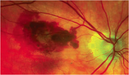 About 10% to 15% of dry AMD patients convert to the wet form.
Image courtesy of Michael Colucciello, M.D.