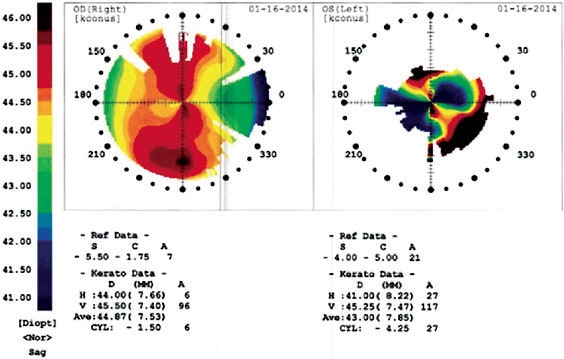 Topography can give the eye care practitioner a starting point for the amount of irregularity that is needed to correct during a scleral lens fitting.
Image courtesy of Jason Miller, O.D., M.B.A., F.A.A.O.