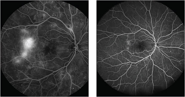 Figure 1. Photos of a right eye with active, high-risk PDR. Prior to treatment, the patient’s visual acuity was 20/25. After 9 months and 5 doses of Lucentis, her visual acuity is 20/20-2.
Images courtesy of David Eichenbaum, MD