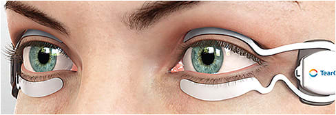 TearCare (Sight Sciences) is a thermal treatment for DED.
Photo courtesy of Sight Sciences
