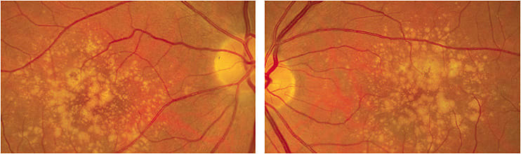 AMD presentation in fundus image. Stages of the disease, early to intermediate, are defined by size of drusen.
Images courtesy of Dr. Sherrol Reynolds