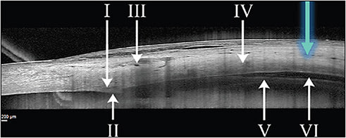 Figure 2. Anterior-segment optical coherence tomography demonstrating spread of suprachoroidal injection of triamcinolone acetonide within the suprachoroidal space 30 minutes after suprachoroidal injection.25 Image courtesy of Clearside Biomedical, Inc