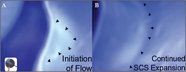 Figure 5. Endoscopic visualization of suprachoroidal injection showing (A) deformation as injectate is started and (B) continued suprachoroidal space expansion as injectate delivered with the black arrows demonstrating inherent boundary of suprachoroidal space. Adapted from Marcus D. Comparison of suprachoroidal and intravitreal injection flow mechanics analyzed via multimodal imaging. Presented at The Retina Society Annual Meeting, 2021. Image courtesy of Clearside Biomedical, Inc
