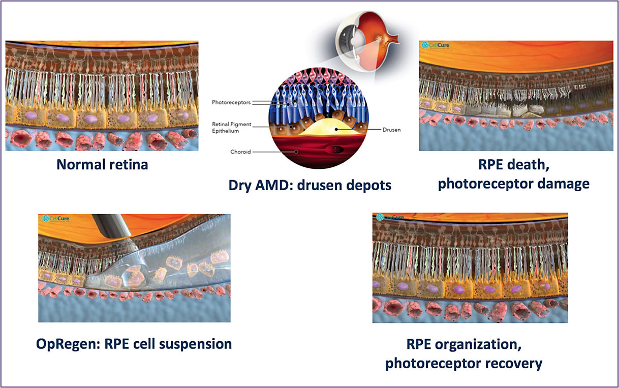 Figure 1. OpRegen cell transplant therapy to repair damaged retina in dry AMD.
IMAGE COURTESY BIOTIME.