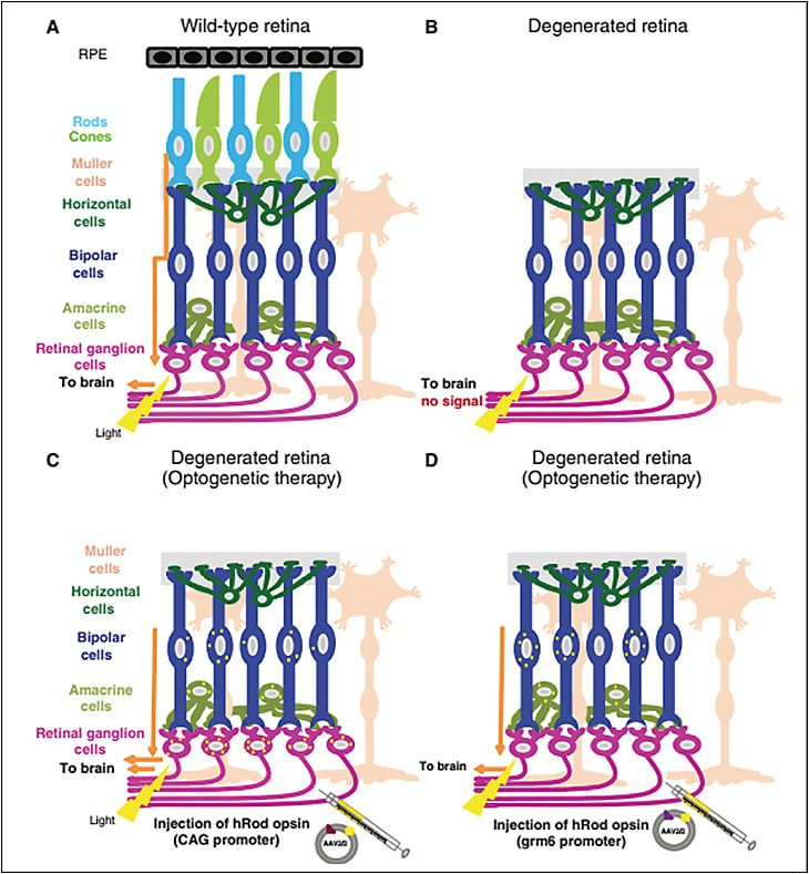Figure 1. Gene therapy rescue of vision in retinal degeneration. In the healthy retina, light penetrates from the inner to the outer retina to reach the cones and rods, which transduce signals through horizontal, bipolar, amacrine, and ultimately retinal ganglion cells to the brain (A). Loss of photoreceptors in outer retinal degenerative disease renders the retina insensitive to light (B). Gene therapy with adeno-associated virus type 2 expressing human rhodopsin under control of the CAG promoter results in expression of the photopigment in many surviving cells of the inner retina, and results in restoration of light responses recognized by the brain (C). More selective expression of rhodopsin in a subset of bipolar cells is achielved by use of a virus in which expression is driven by the grm6 promoter (D). This version appeared to restore the most natural visual function to blind mice. Figure reprinted with permission of Elsevier from Van Gelder et al.21