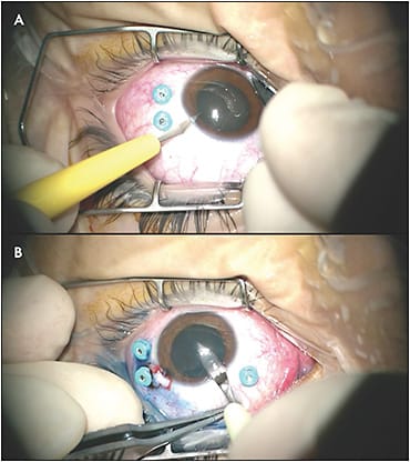 Figure 2. The paracentesis (A) and primary clear corneal incision (B) are performed superior to the trochar–cannula system to avoid any limitations during maneuverability.