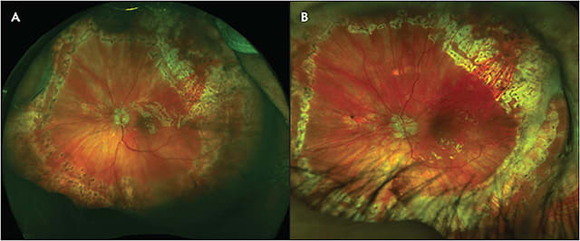 Figure 3. This patient had a history of multiple retinal detachment repairs with vitrectomy, endolaser, and silicone oil placement. Note the superonasal peripheral exudative hemorrhagic chorioretinopathy lesions. Recurrent inferotemporal retinal detachment was noted from about 3 o’clock to 7 o’clock positions with prior dense laser (A). Due to the dense laser, a complete 180° inferior retinectomy could not be achieved (B). A scleral buckle was placed to support the inferior horn at approximately the 6 o’clock position. Note the oblique angle of the temporal horn of the retinectomy. Images courtesy of Xi Chen MD, PhD.