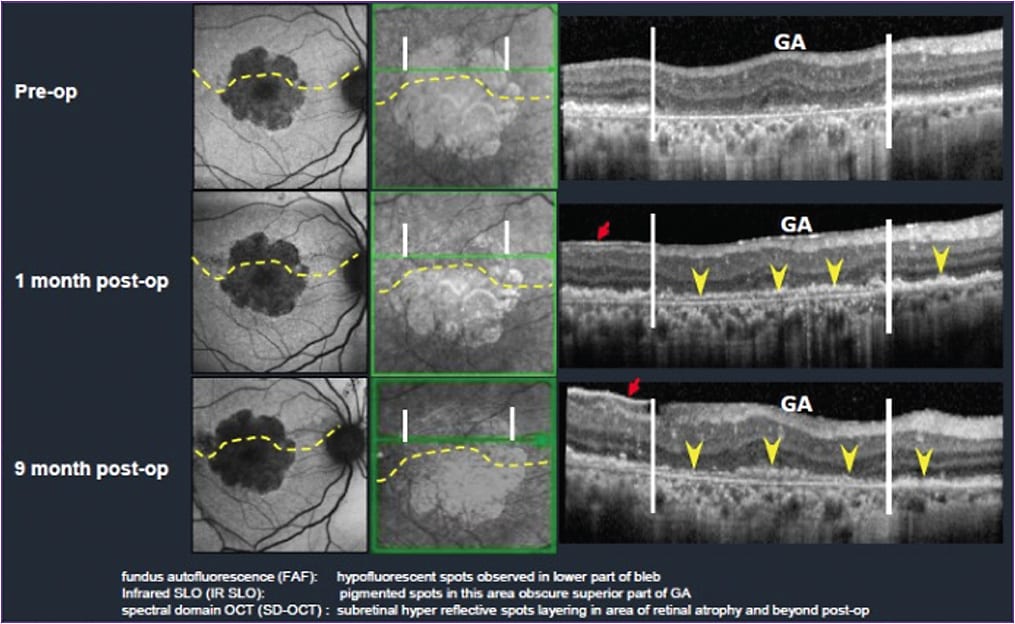 Figure 2. Subretinal layering of transplanted hESC-RPE.