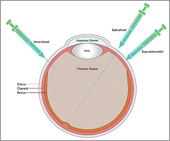 Figure 1. Retinal drug delivery routes.