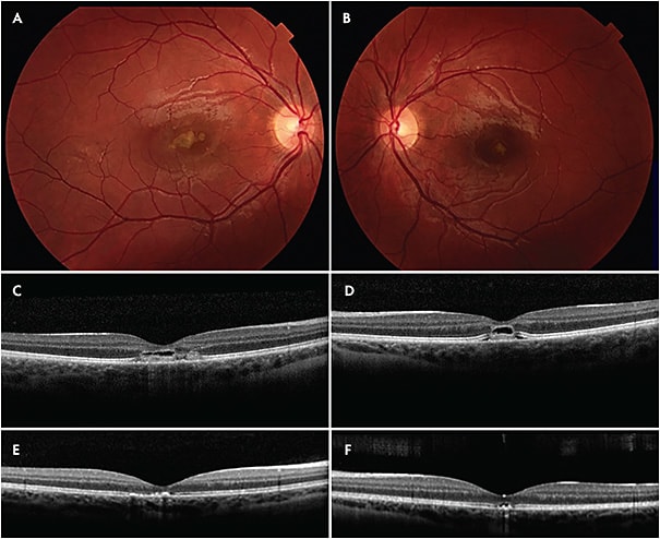 Figure 4. Laser-induced retinopathy. This 14-year old male with a history of attention-deficit disorder on methylphenidate reported blurry vision after playing with a laser pointer. On presentation, pinhole vision was 20/400 in the right eye and 20/300 in the left eye. Fundus photos (A, B) show yellowish discoloration of the macula, and optical coherence tomography (C, D) shows outer retinal disruption. This patient was treated with a Medrol dose pack, and 10 weeks after presentation vision improved to 20/40 in the right eye and 20/30 in the left eye with correction, and demonstrated improvement in outer retinal disruption on optical coherence tomography (E, F).
IMAGES COURTESY OF JAYANTH SRIDHAR, MD.