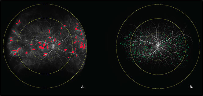 Figure 3. Computer aided leakage and microaneurysm analysis of an ultra-widefield fundus angiogram. Red areas represent leakage segmentation (A), green dots represent microaneurysms (B).