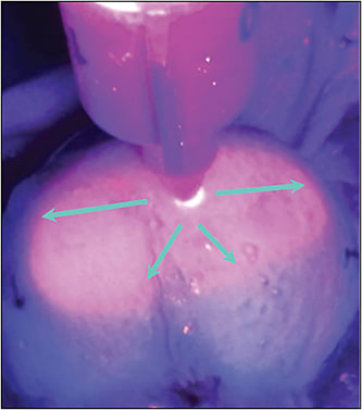 Figure 4. Injection of fluorescing dye under ultraviolet light within the suprachoroidal space in an ex vivo porcine eye demonstrates posterior and circumferential spread. Image courtesy of Clearside Biomedical, Inc