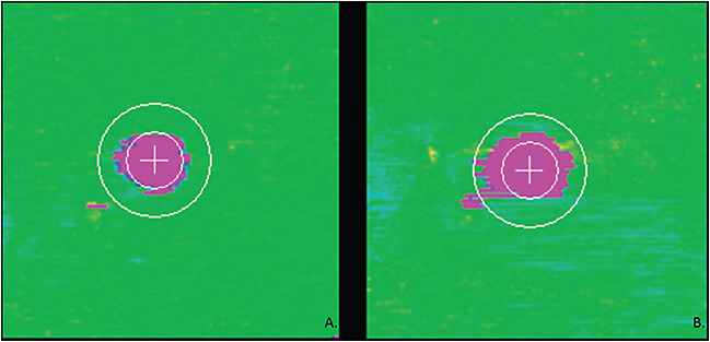Figure 2. Automated thickness maps of the distance between ellipsoid zone (EZ) and retinal pigment epithelium demonstrating progression of EZ disruption over a year in a patient with age-related macular degeneration. Green areas represent intact EZ and pink areas represent total EZ loss. Ellipsoid zone integrity map at the initial visit (A). Ellipsoid zone integrity map at 12-month follow-up (B).