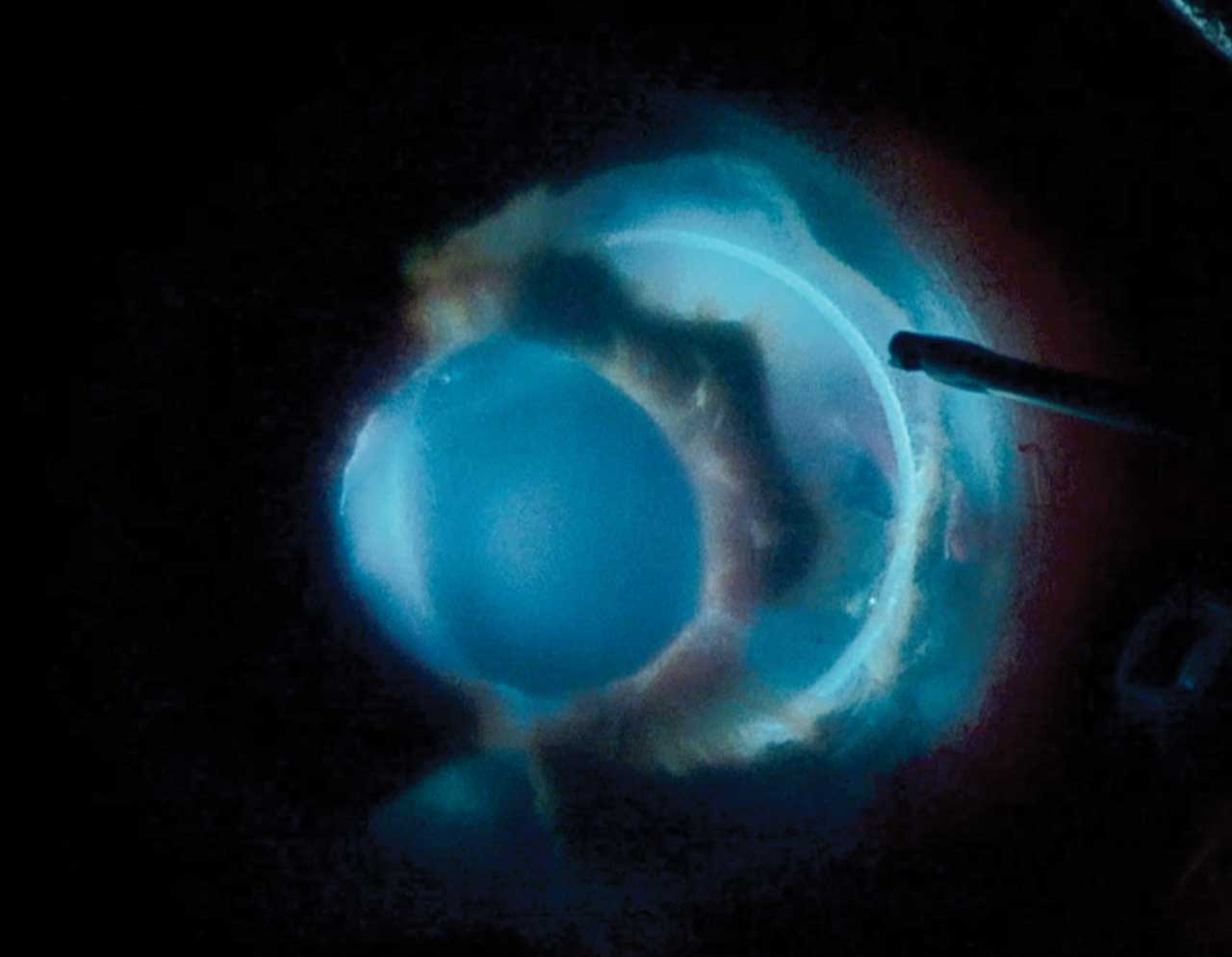 Figure 1. An eye with uveitis-glaucoma-hyphema syndrome from a sulcus intraocular lens and extensive iris atrophy and multiple episodes of vitreous hemorrhage and hyphema.
