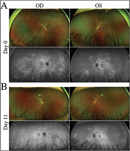 Figure 3. Fundus autofluorescence imaging (Optos) highlights the extent of chorioretinal involvement in Vogt-Koyanagi-Harada (VKH) disease. Initial presentation of patient with active VKH disease (A) revealed extensive serous RDs in both eyes (top) along with hyperautofluorescence (hyperAF) appearance highlighting the extent of serous RDs (bottom). After 11 days of high-dose steroid therapy (B), the serous RDs improved greatly on fundus photography (top) and autofluorescence; however, residual hyperAF remain in regions of prior RD (bottom).