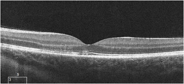 Figure 6. Optical coherence tomography shows focal areas of increased hyperreflectivity in the outer nuclear layer and defects in the ellipsoid zone.
