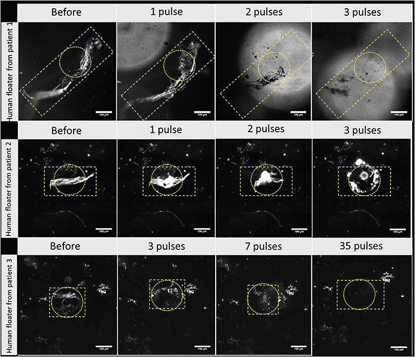 Figure 2. Nanobubble/laser ablation of human vitreous opacities. Dark-field microscopy of human vitreous opacities (surgical specimens from 3 different patients) treated in vitro with 10 nm HA-AuNPs (concentration 1,012 particles/mL). The specimens were exposed to varying numbers of laser pulses (800 &#x3BC;J; ~4.5 J/cm2). Vitreous opacities (yellow rectangles) and the laser beam (circles). Significant ablation of vitreous opacities can be observed with increasing numbers of pulses.7