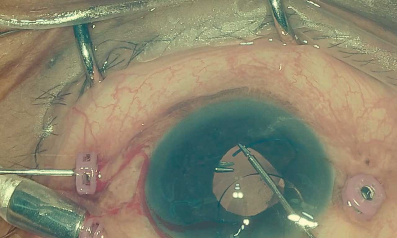 Figure 4. Tip of haptic being grasped by 27-gauge forceps for the streamlined modified Yamane technique.