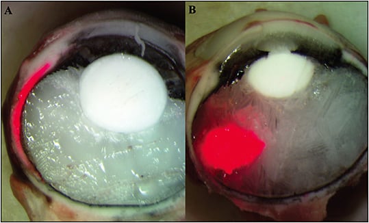 Figure 3. Distribution of dye injectate in ex vivo porcine eyes immediately frozen after (A) suprachoroidal injection and (B) intravitreal injection. Image courtesy of Clearside Biomedical, Inc