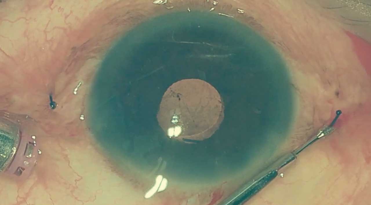 Figure 3. Extruded haptics of an intraocular lens during a Yamane technique with cauterization of the tips. The haptics are being trimmed with scissors to stabilize the optic.