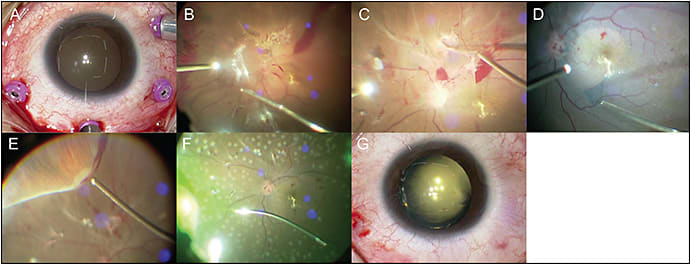 Figure 4. Various images of 27-gauge diabetic vitrectomy: 3-port surgery with 27-gauge chandelier endoillumination fibers (A); vitreous hemorrhage removal with a 27-gauge vitreous cutter (B); fibrovascular membrane peeling with the cutter (C); lnternal limiting membrane peeling with 27-gauge forceps (D); peripheral vitreous shaving with the cutter (E). The beveled tip of the 27-gauge cutter enables removal of vitreous hemorrhage closer to the retina. Panretinal endophotocoagulation