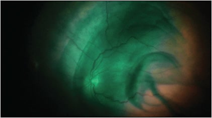 Figure 2. Indocyanine green being injected to stain the internal limiting membrane.